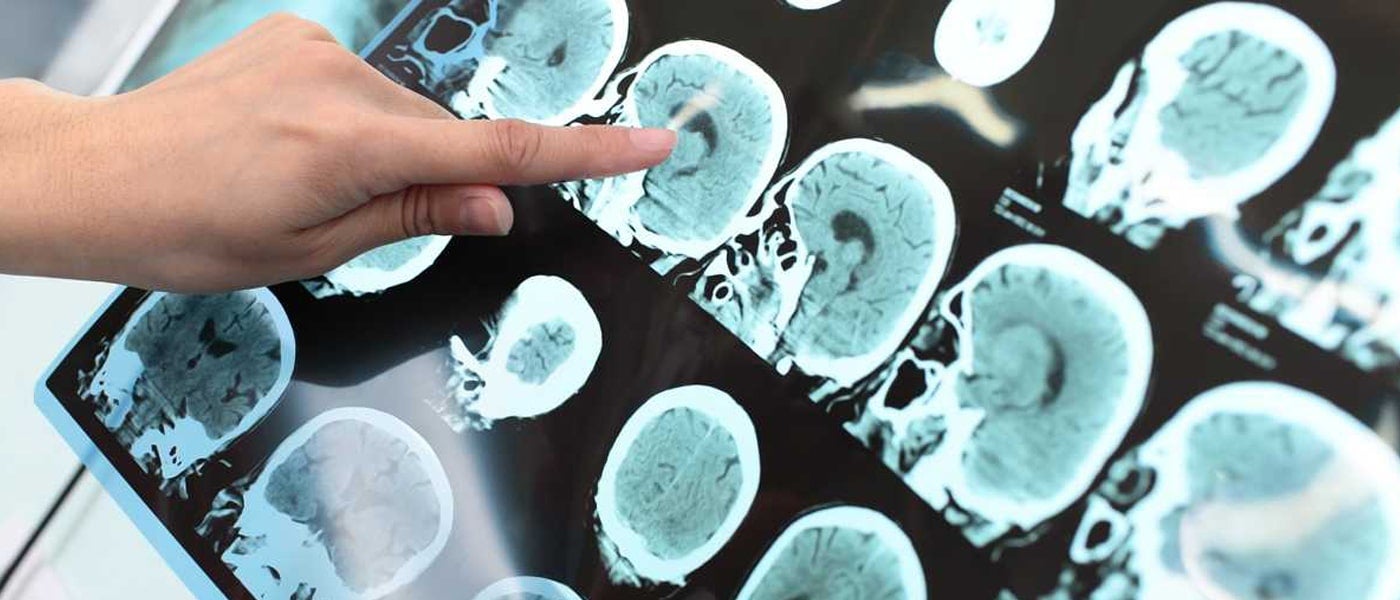 alzheimer's ntrx-07 alzheimer's treatment amyloid plaques