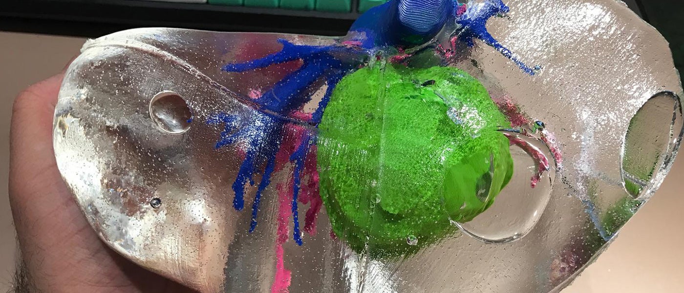 3d printing medicine surgery liver