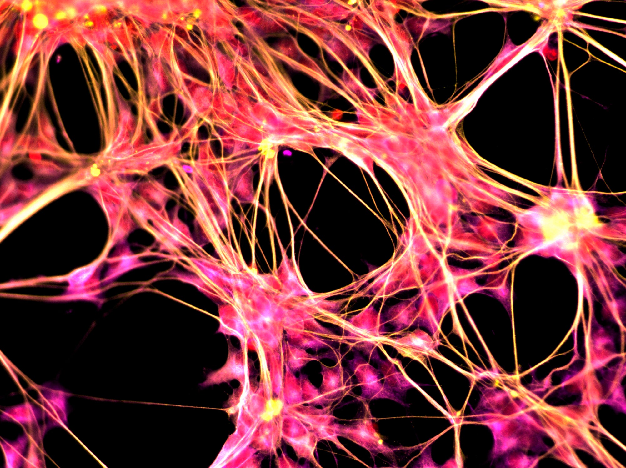 alzheimer's stem cells neurological disorders
