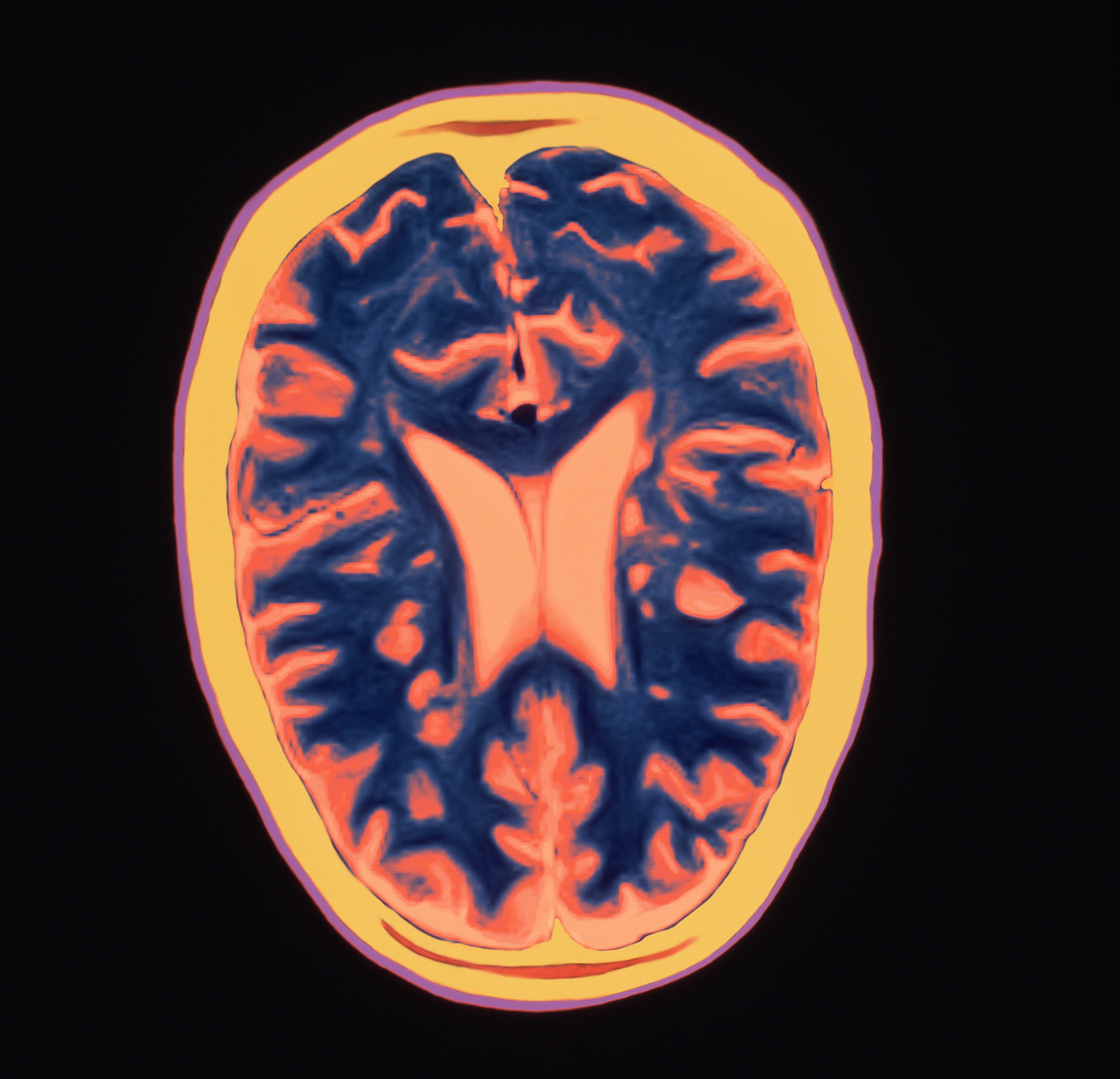 ocrelizumab ms primary progressive ms