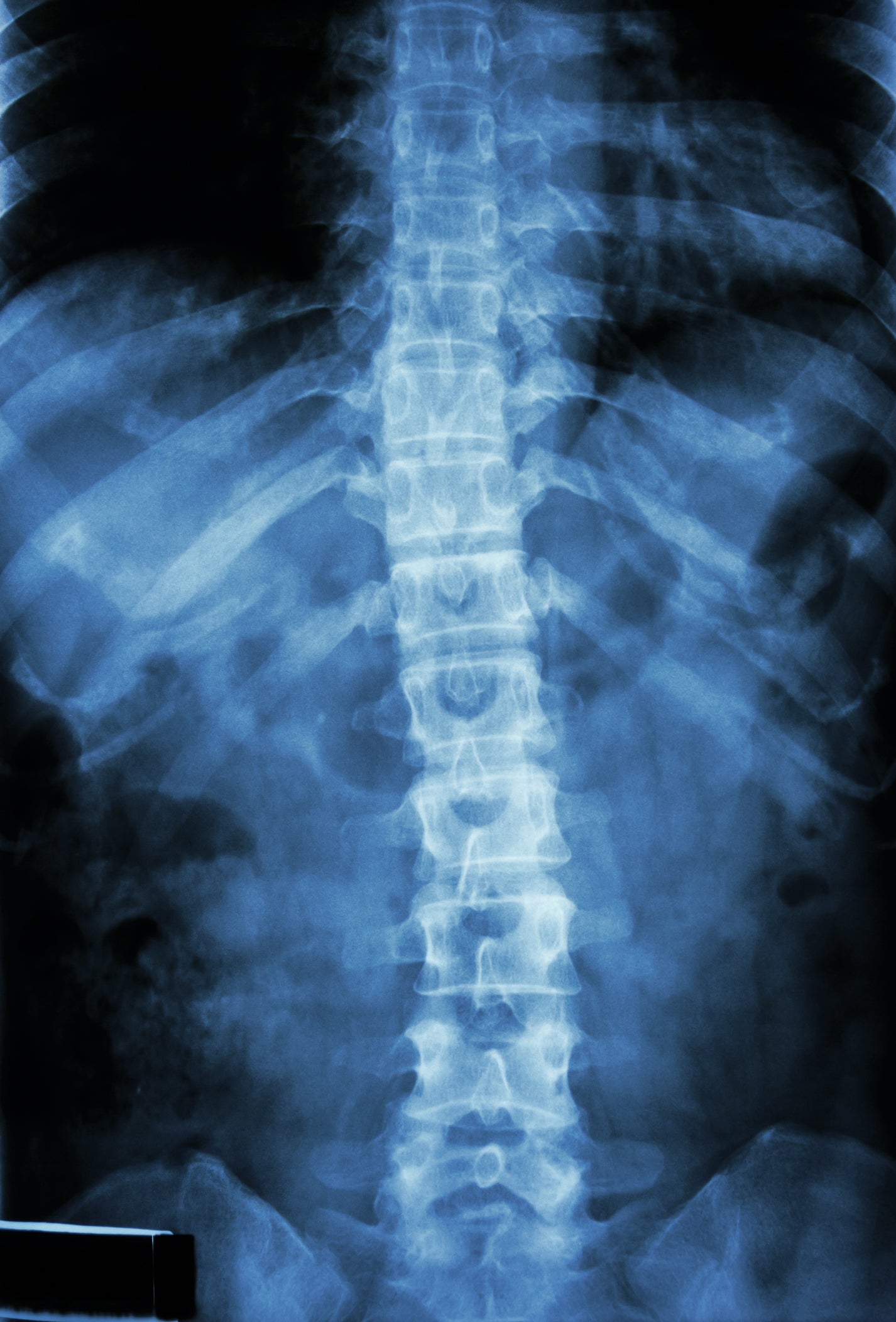 spinal cord injuries paralysis electrical stimulation therapy epidural stimulation therapy