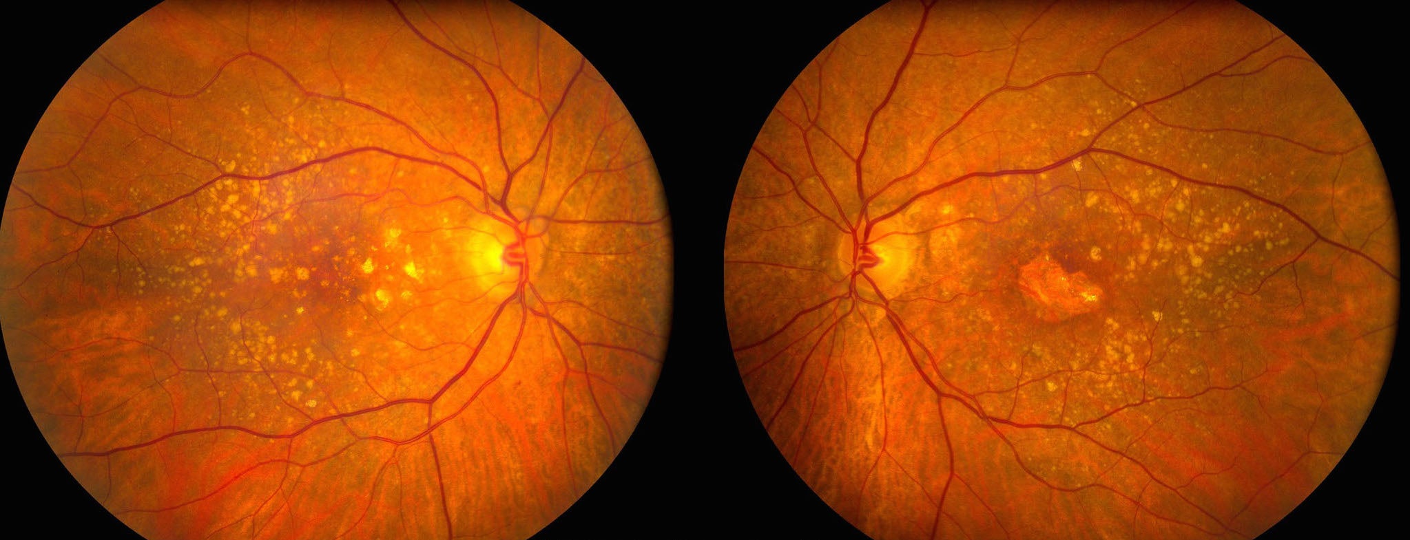 age-related macular degeneration gene therapy wet amd blindness