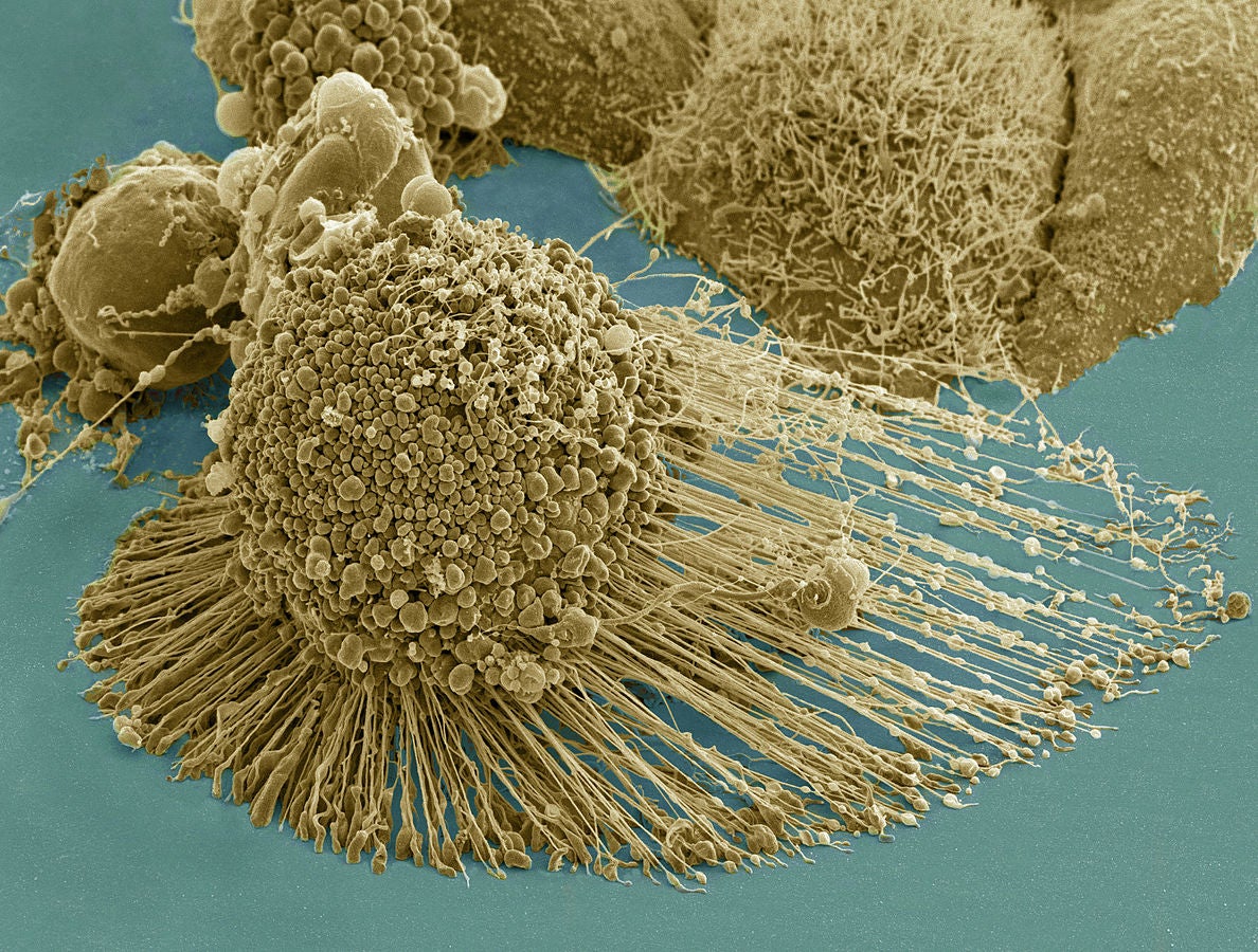 cancer metastasis laser gold rod