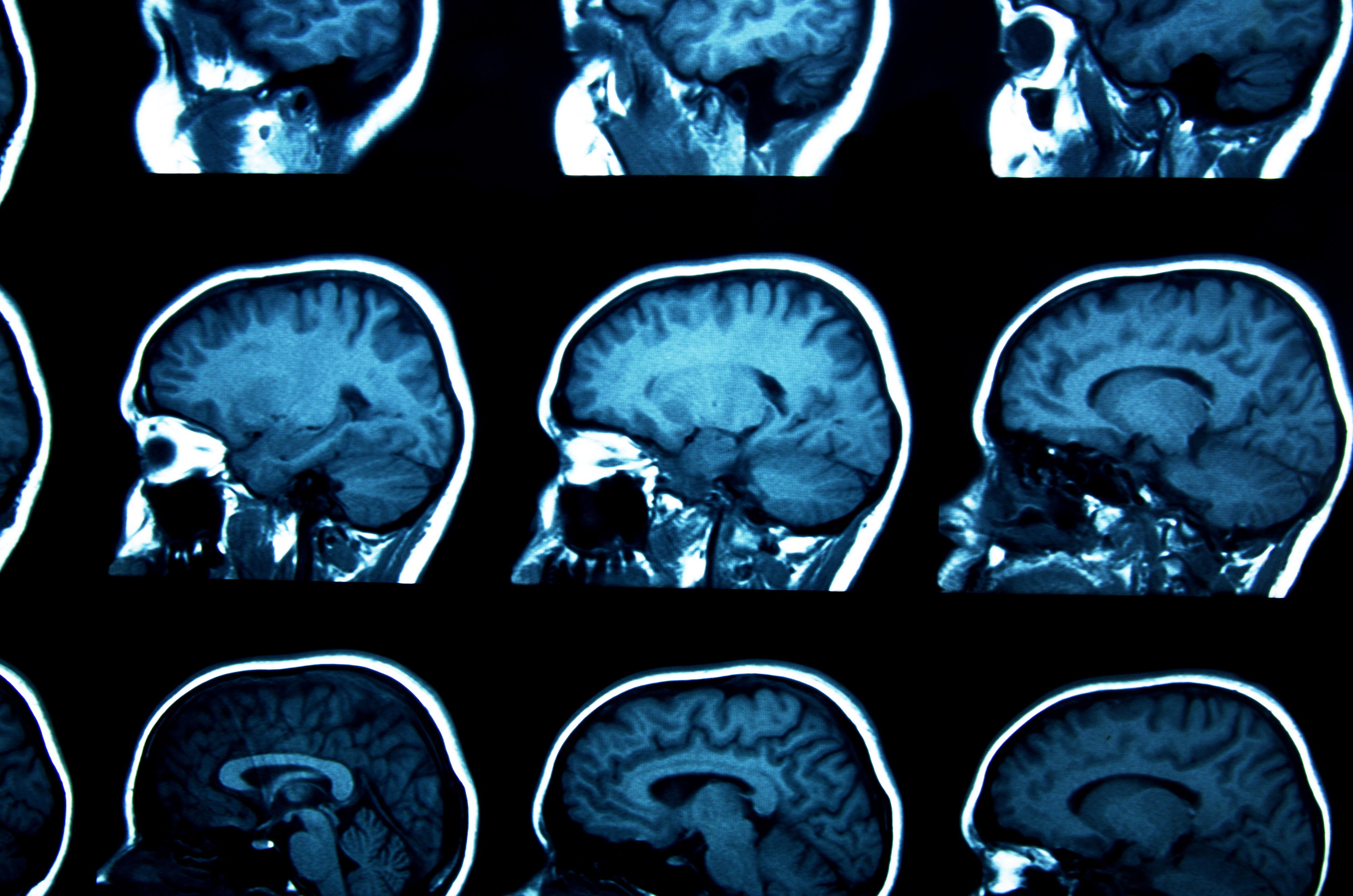 schizophrenia treatment antipsychotic