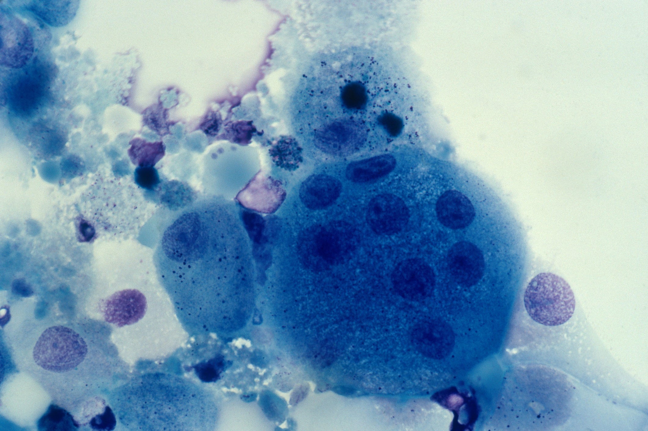 hiv aids treatment hiv cure