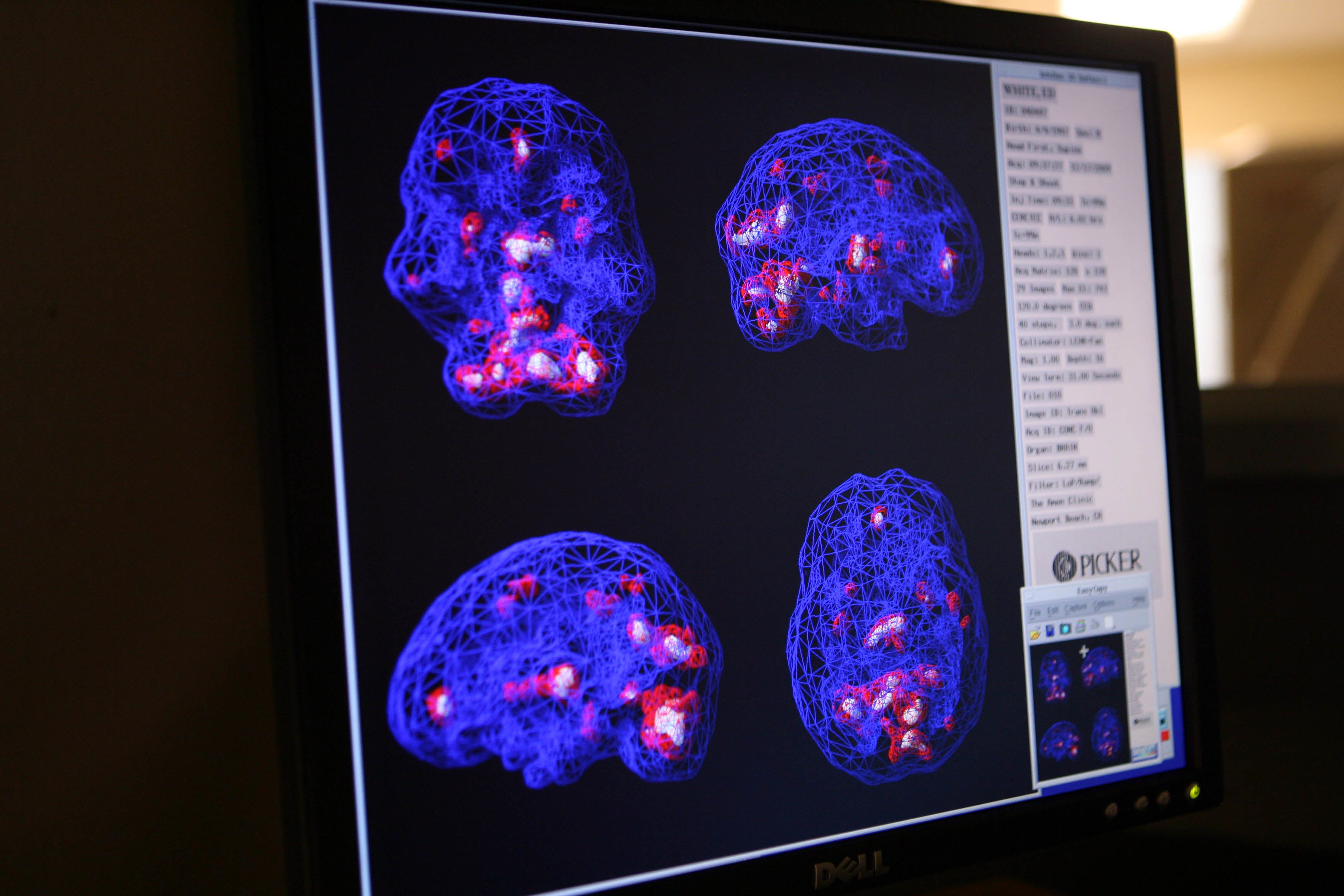 cte chronic traumatic encephalopathy football neuropathology