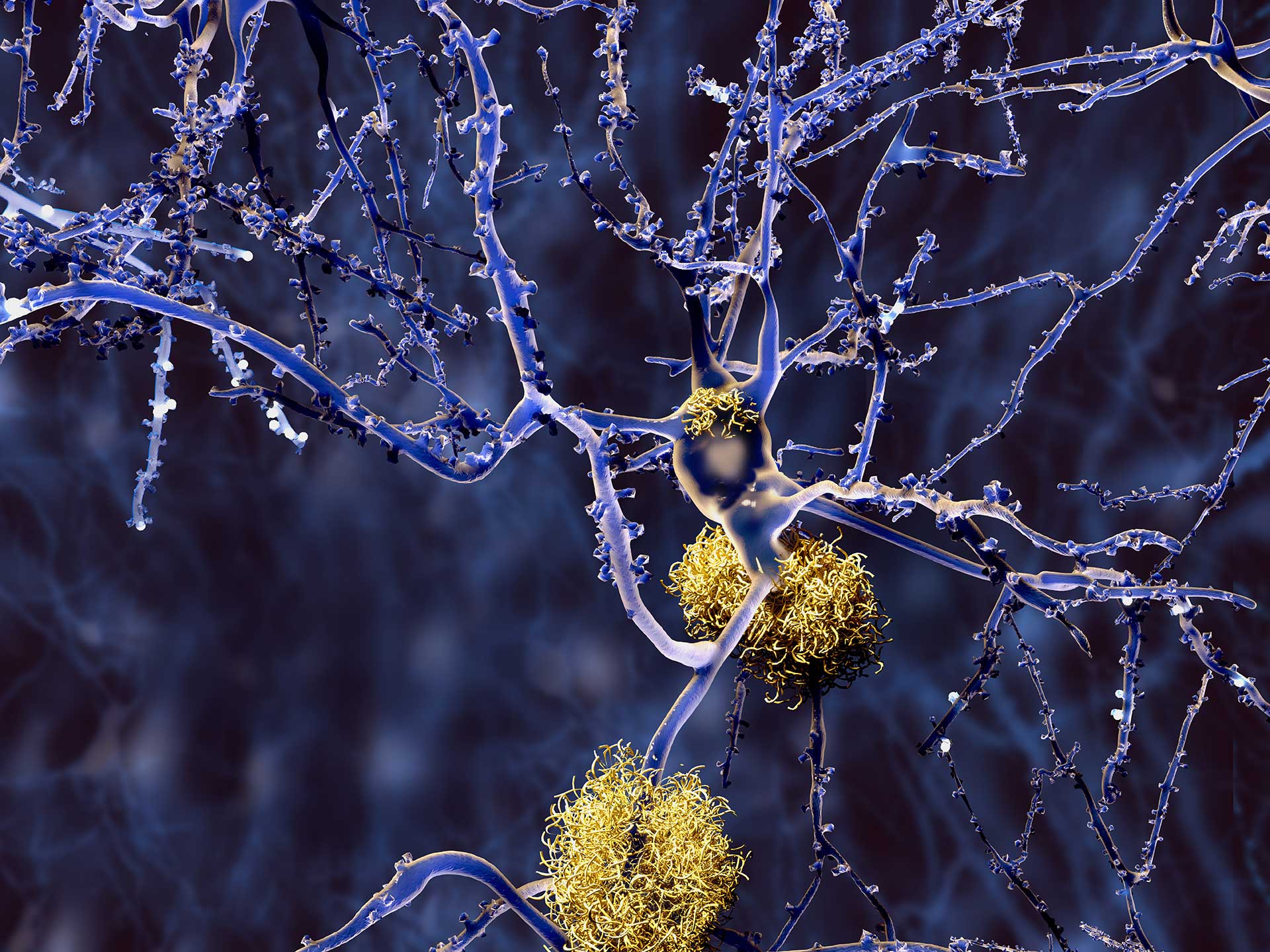 alzheimer's disease alzheimer's vaccine alzheimer's prevention