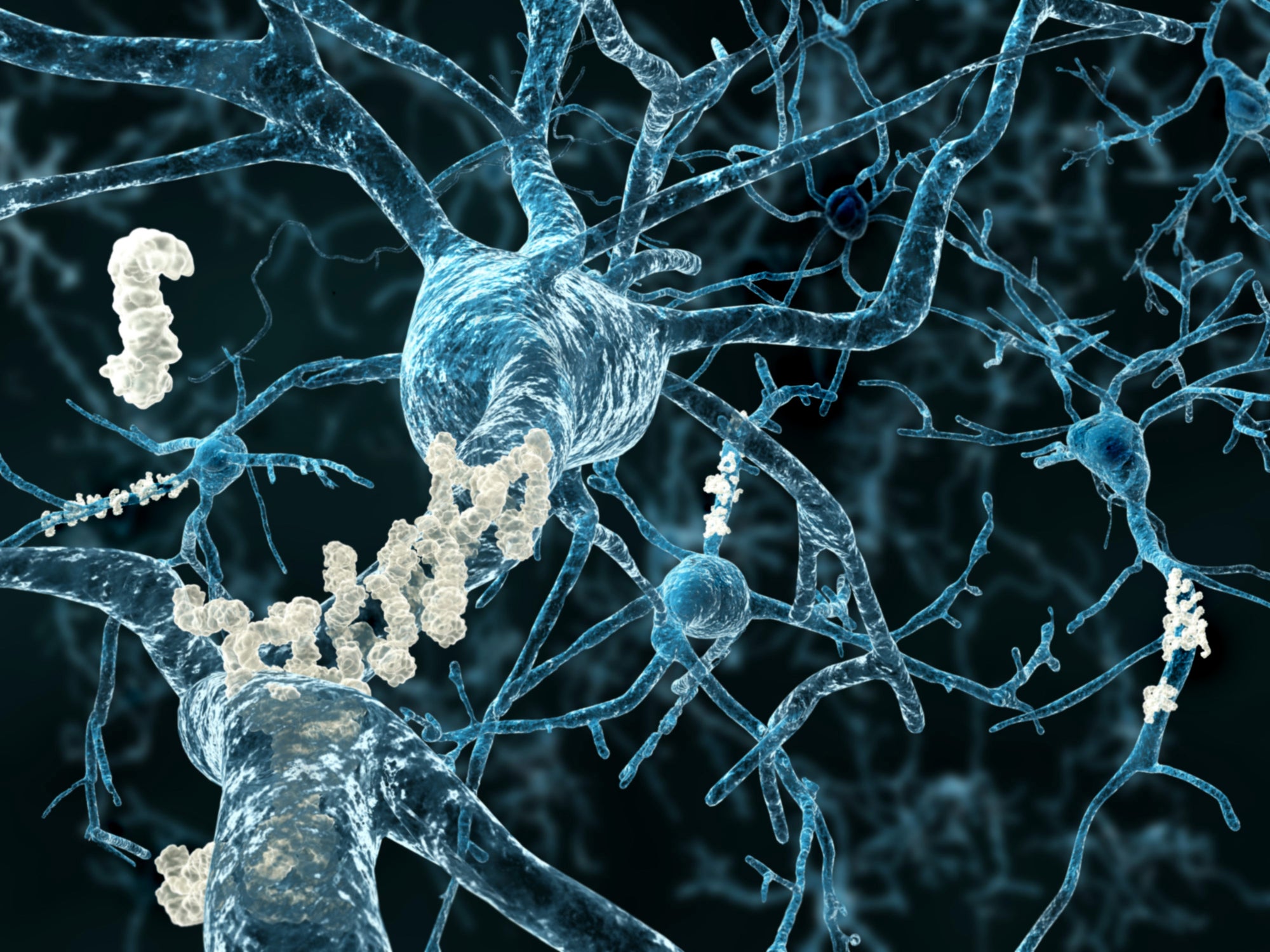 Alzheimer's starts outside the brain