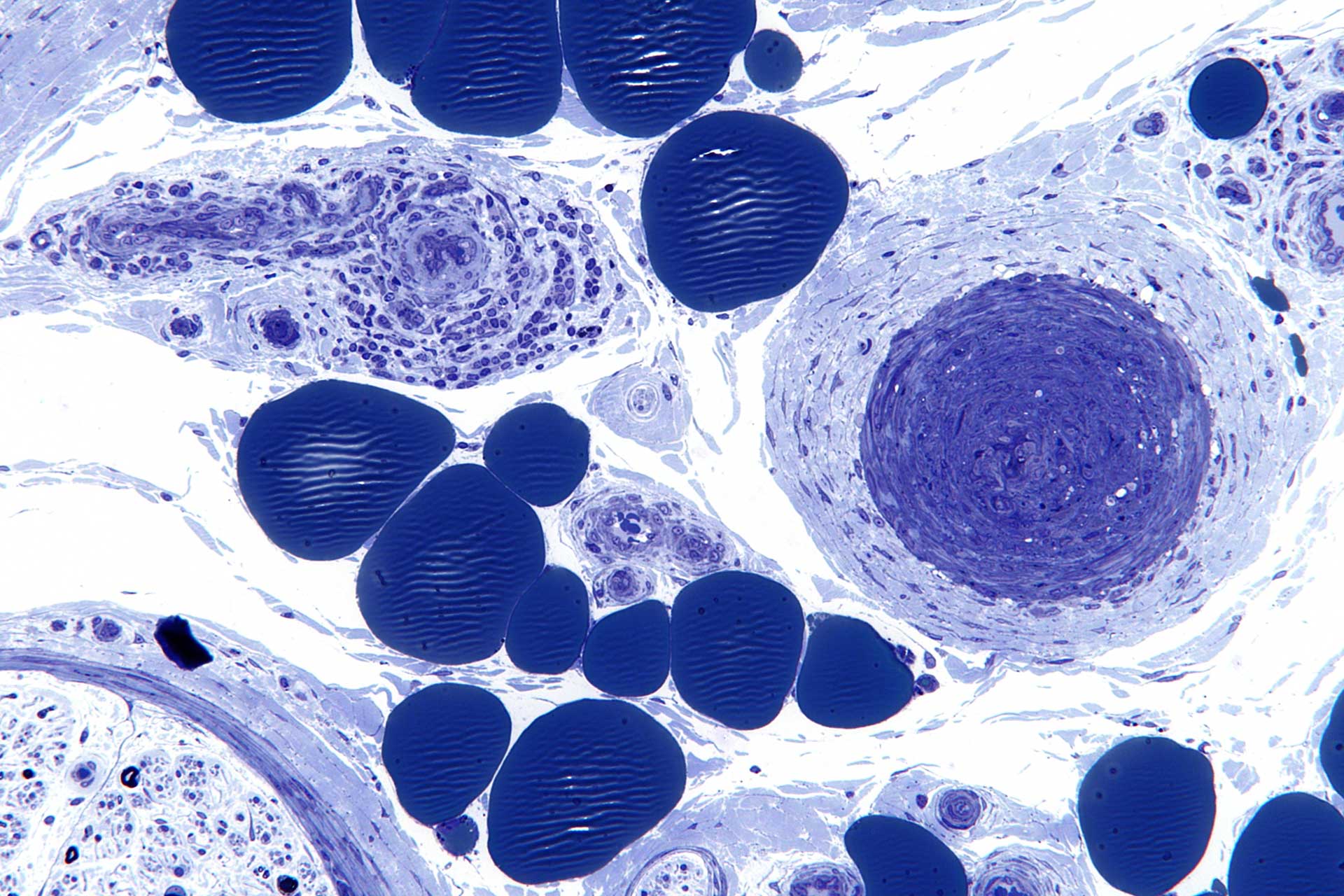 Skin cells could be used to treat many diseases. The picture shows a high magnification micrograph of a vasculitic neuropathy.