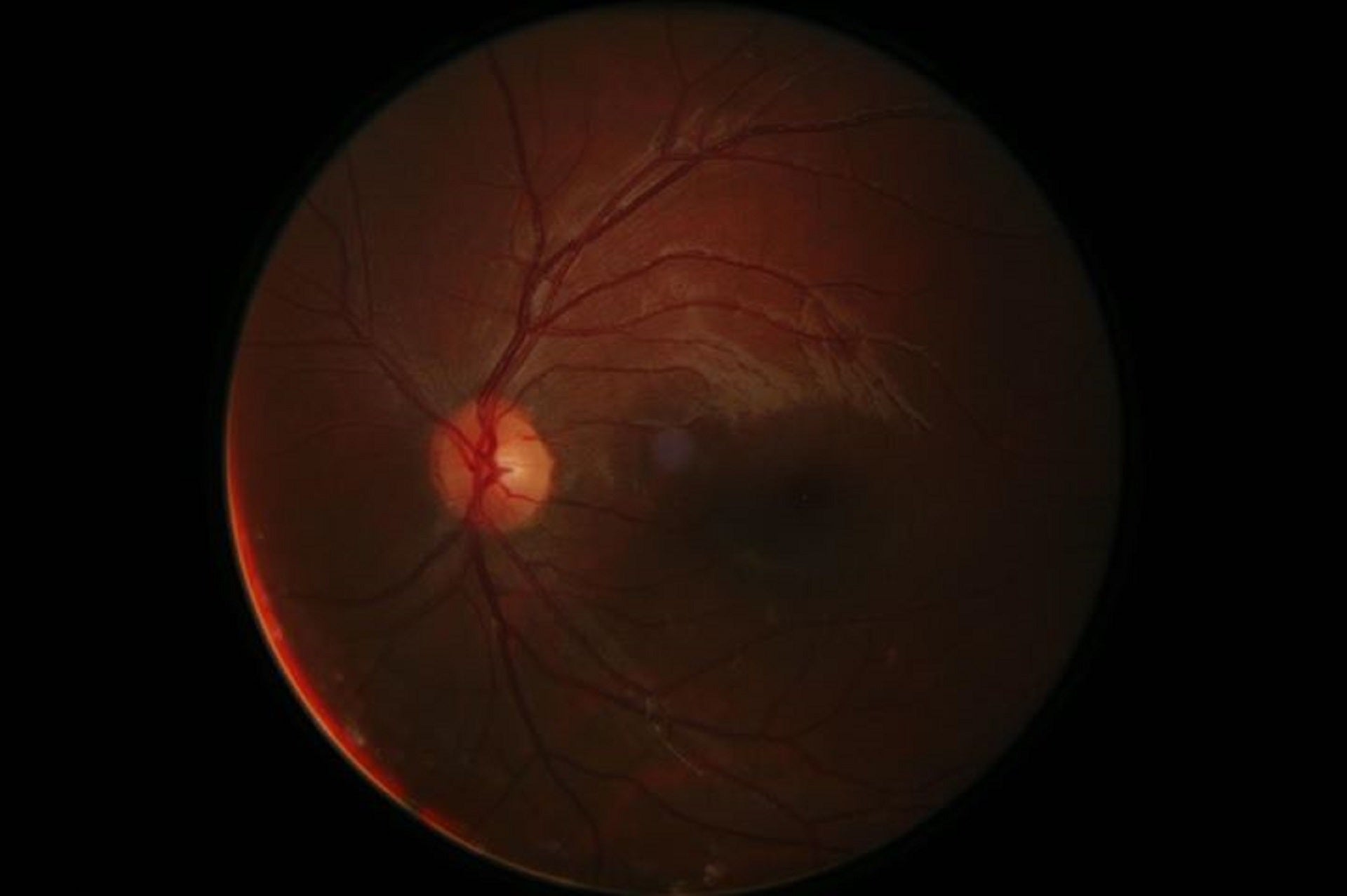 gene therapy blindness opthalmology visual impairment