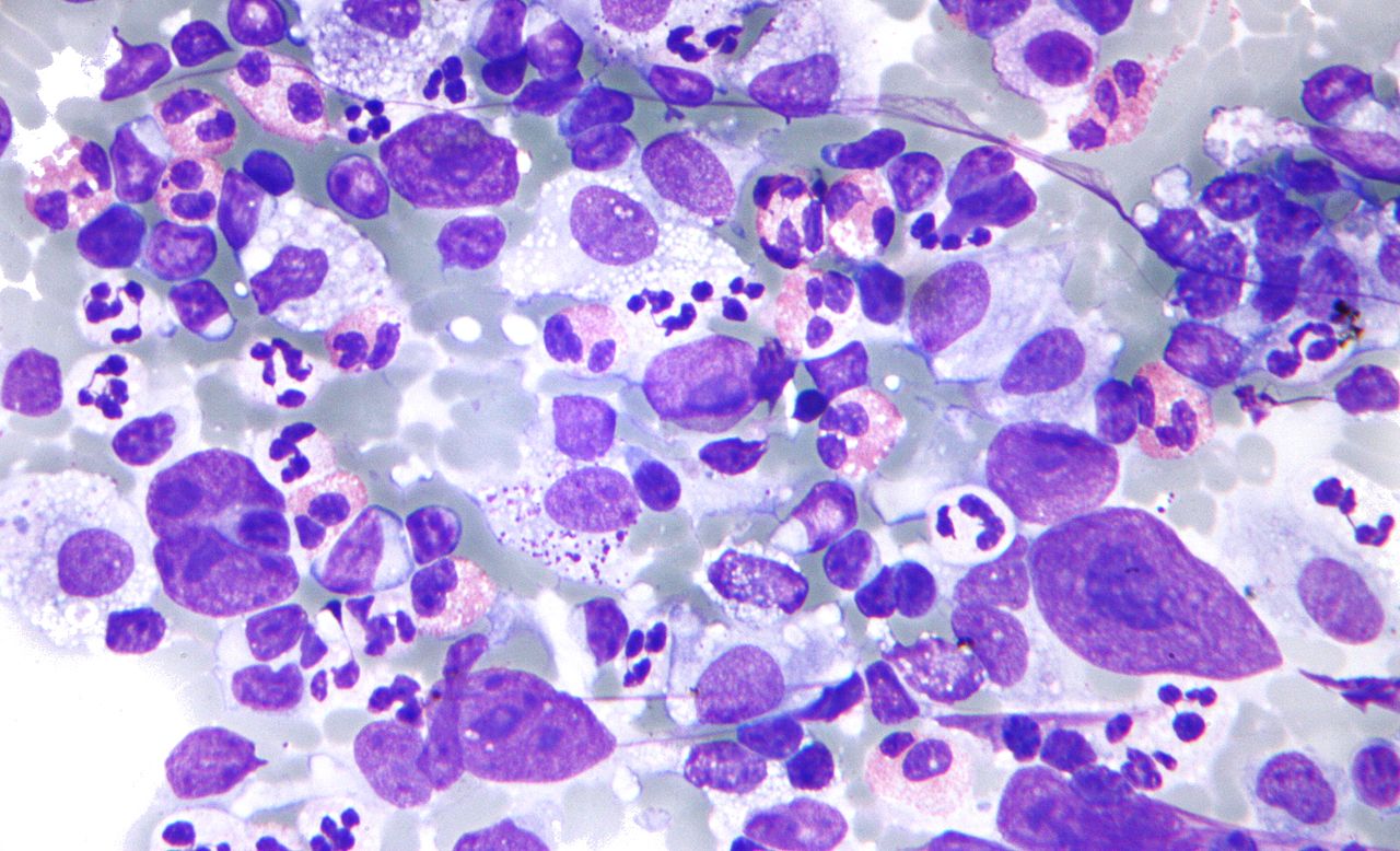 cancer immunotherapy tumor cancer treatment