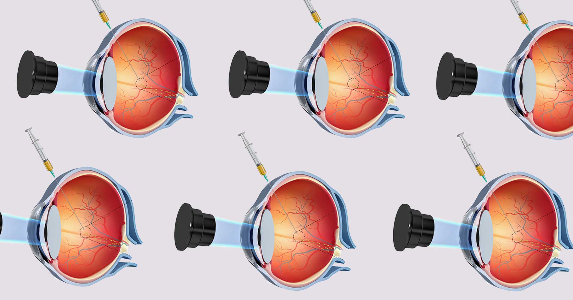 Researchers develop a corkscrew-shaped nanobot they can guide through the dense tissue of an eyeball using a magnetic field.