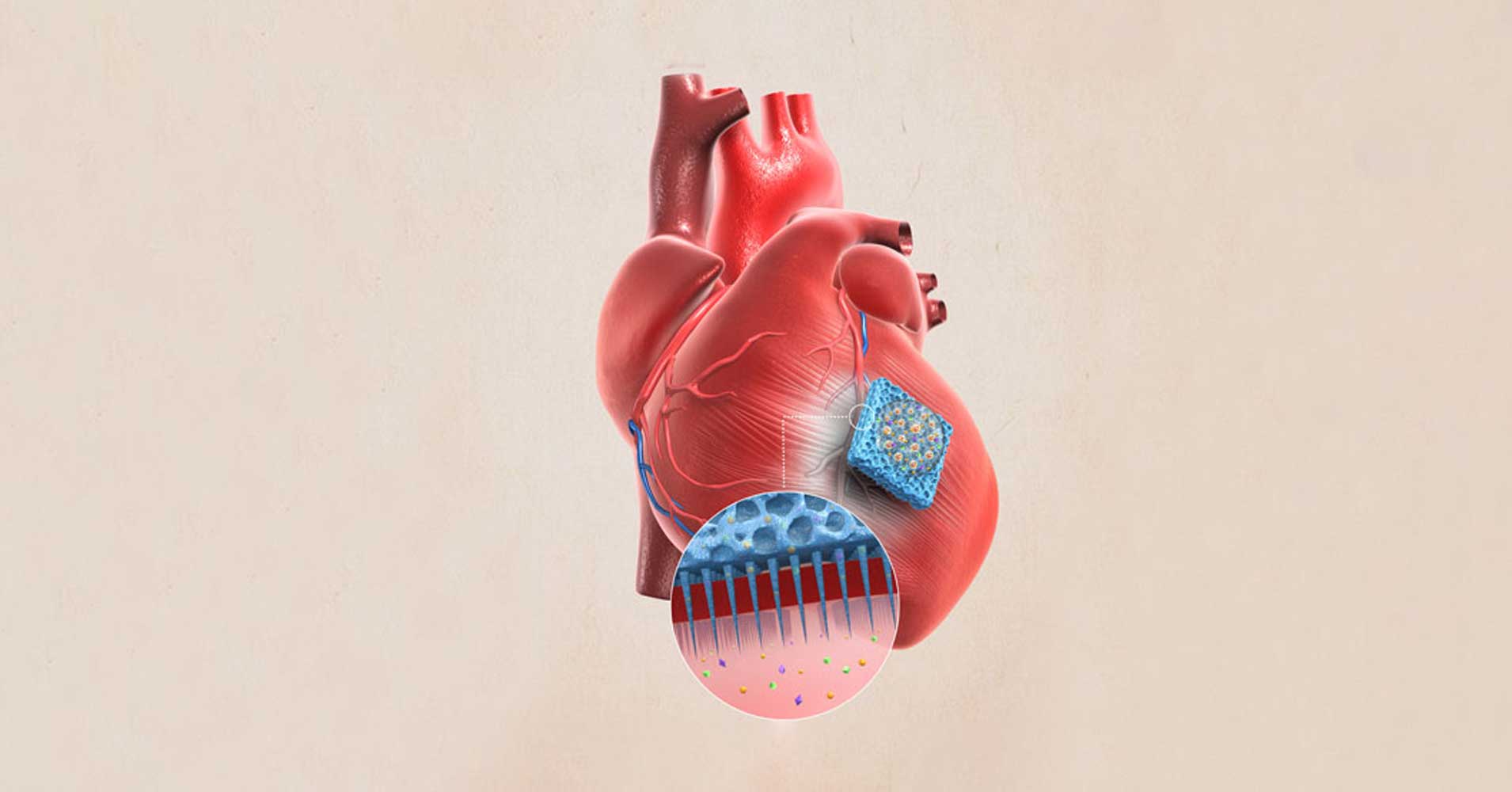 Researchers have created a needle-covered patch that delivers stem cells directly to damaged hearts, helping the organs heal.