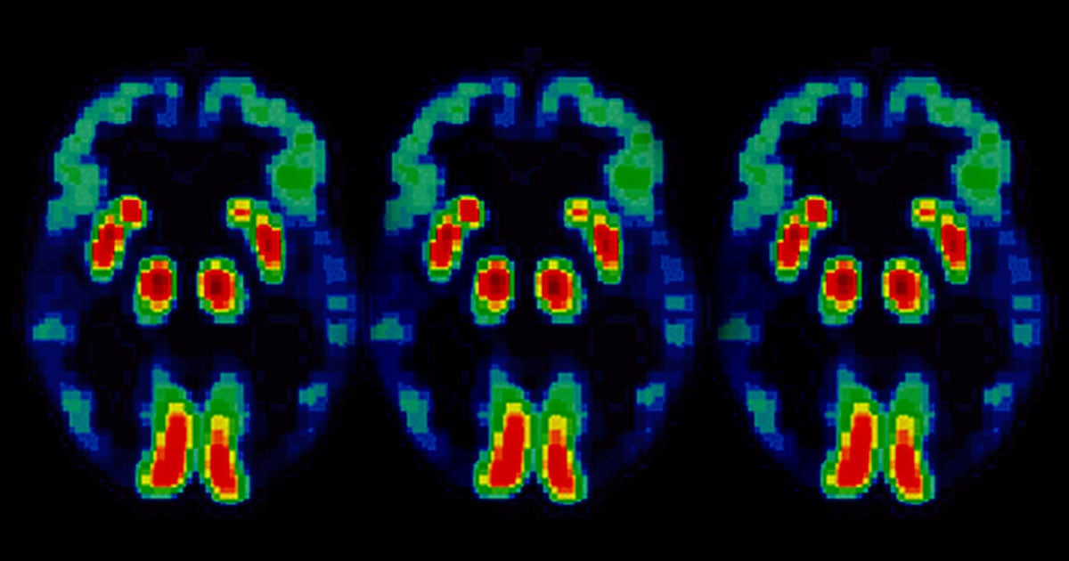 A new clinical trial is recruiting patients to see if a drug that stops ALS-related neuron death can also help people with Alzheimer's Disease.