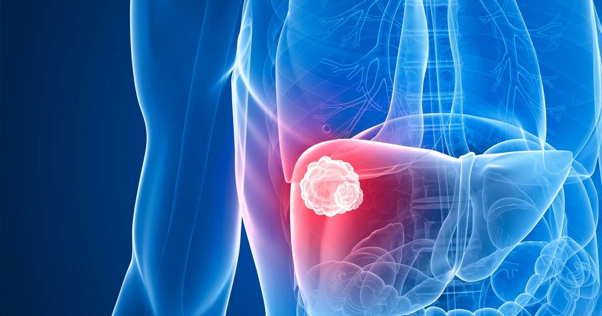 A drug sponge that fits into a patient's vein to help minimize the side effects of chemotherapy could have a short path to FDA approval.