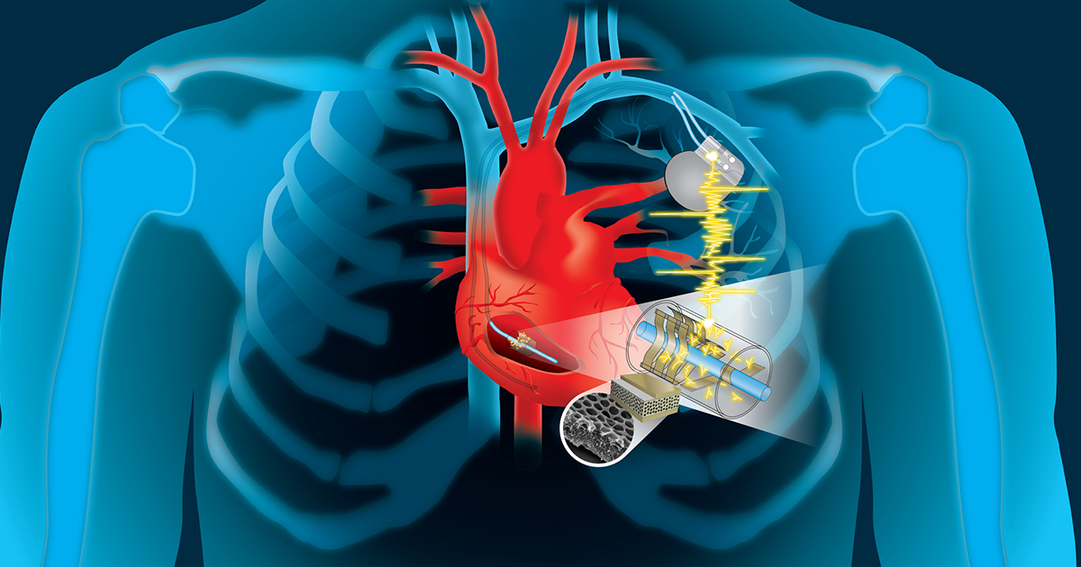 A new medical device could charge pacemakers using the kinetic energy of a person's heartbeat. If it works, it could eliminate costly and risky surgeries.