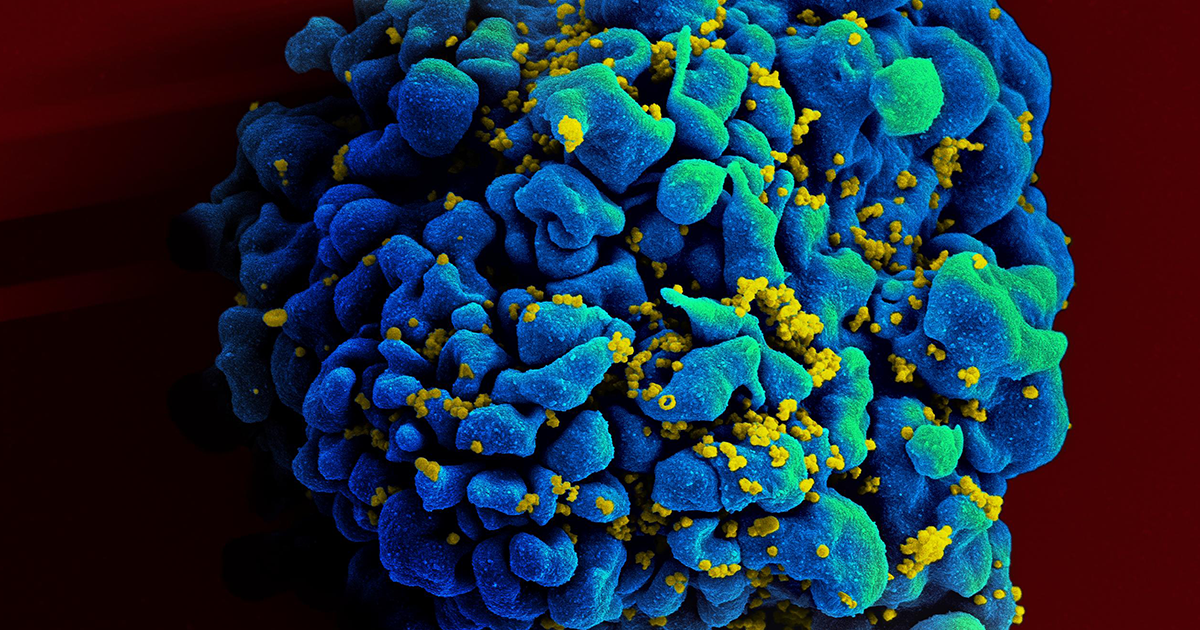 European scientists say that a bone marrow transplant has permanently cured a patient's infection with HIV, which is the virus that causes AIDS.