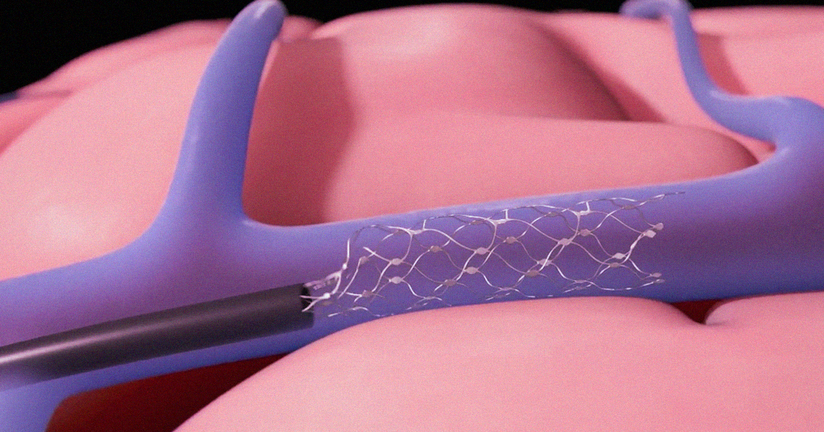 The Stentrode, the first neural implant that doesn't require open surgery, is poised to begin clinical trials to help paralyzed people communicate.