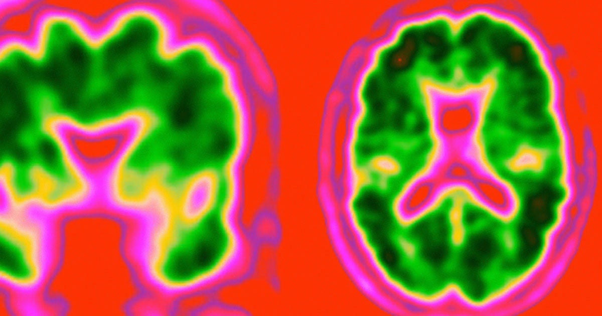Researchers claim they have made significant progress in developing a blood test that can detect Alzheimer's up to 20 years before any symptoms appear.