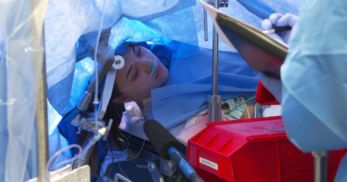 Doctors in Texas recorded a livestream of a brain surgery during which the person under the knife, Jenna Schardt, was awake and talking.