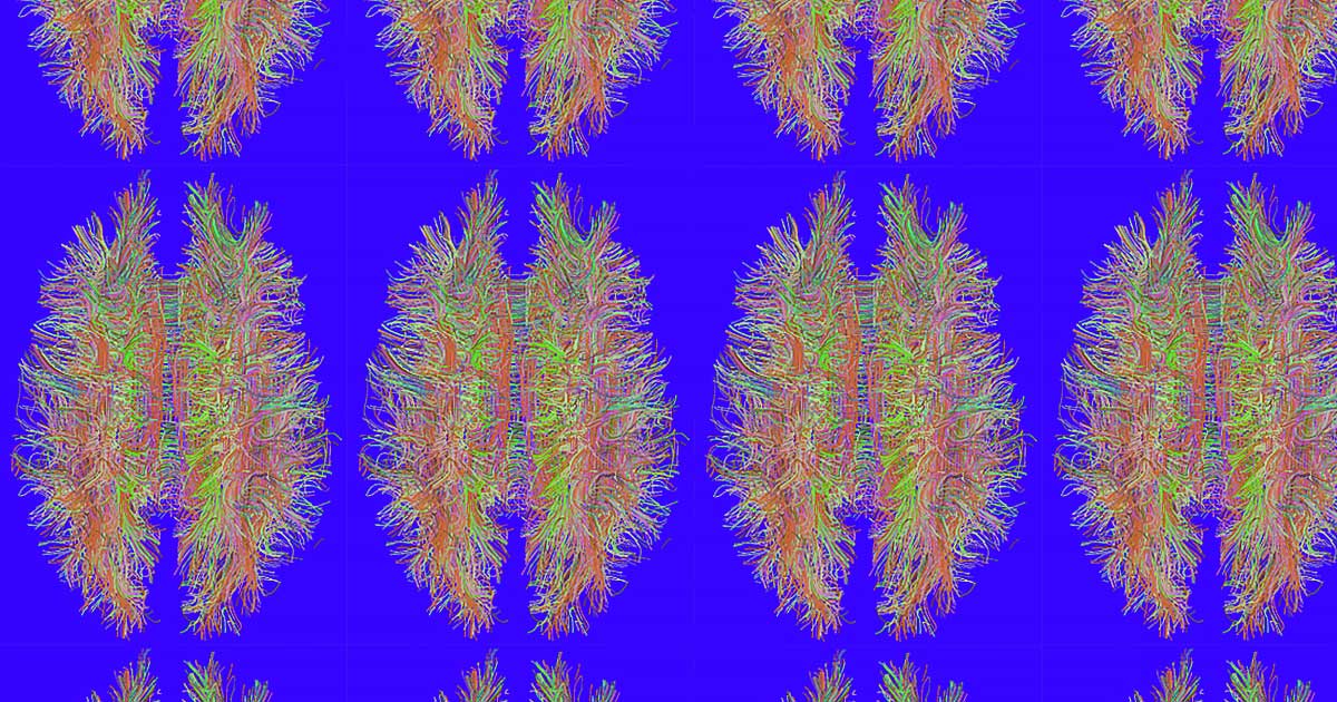 A team of researchers used a type of artificial intelligence (AI) to predict ADHD in patients by having it analyze magnetic resonance imaging (MRI) scans.