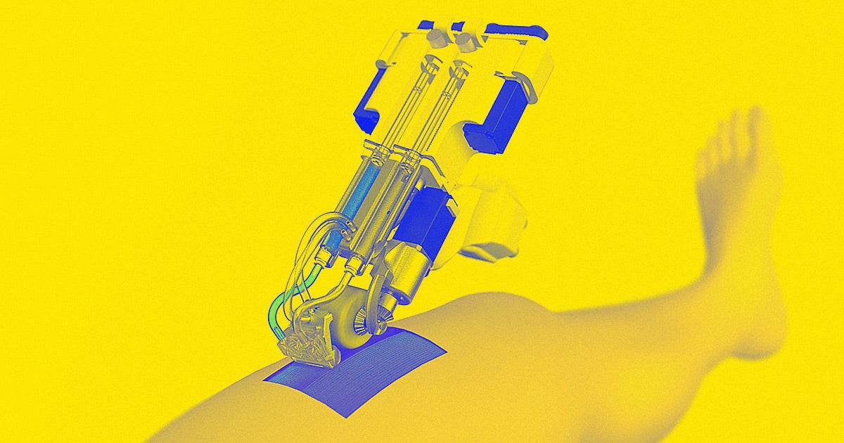 A handheld device that "prints" sheets of artificial skin directly onto the wounds of burn victims is one step closer to actual use in burn clinics.