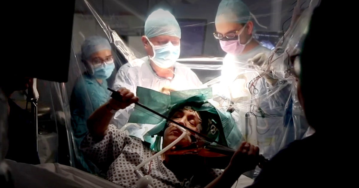 Here's why surgeons kept a talented musician awake and playing violin while they performed surgery on a portion of her brain.