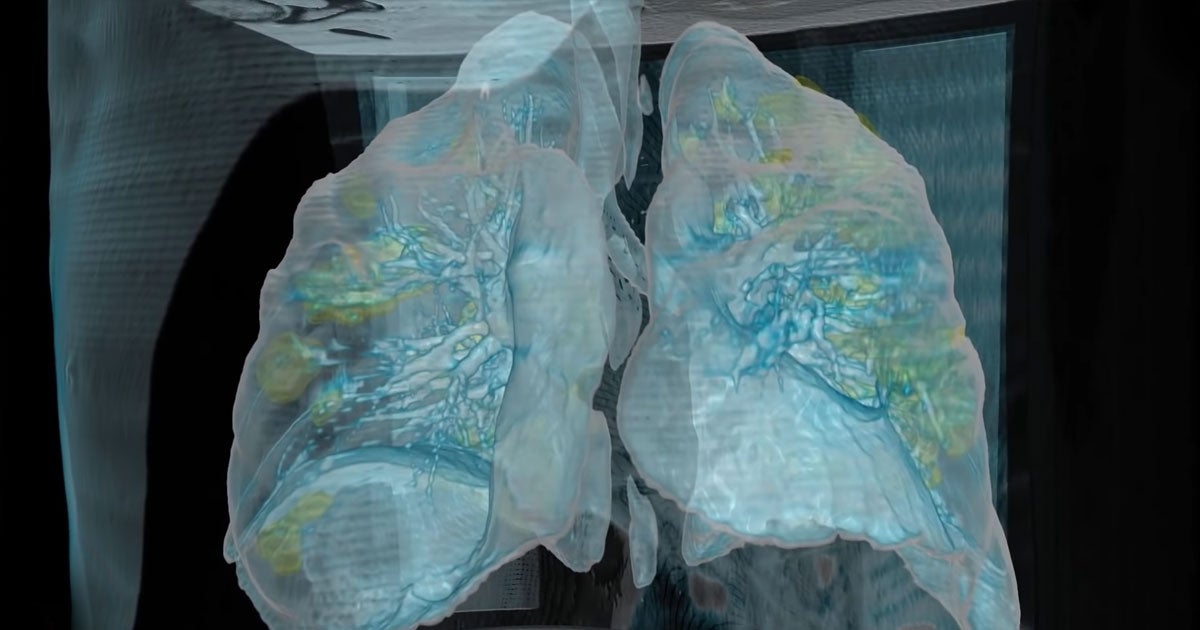 The George Washington University Hospital has released a 3D video of a 59-year-old male COVID-19 patient's lungs days after showing no coronavirus symptoms.