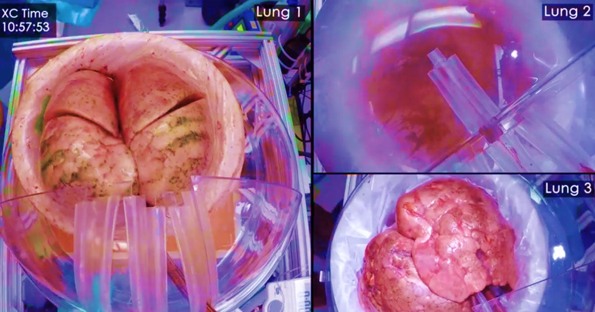 By hooking up transplant lungs to live pigs, researchers were able to extend their shelf life and even rejuvenate them outside the body.