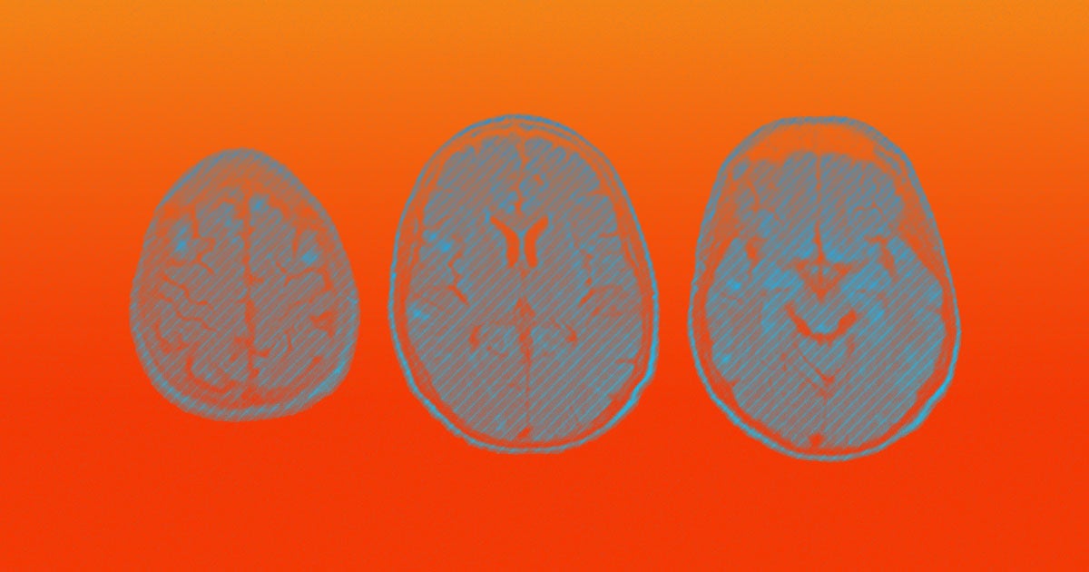 Scientists are warning that we may be overlooking serious brain disorders, triggered by the coronavirus that effect even those with mild symptoms.