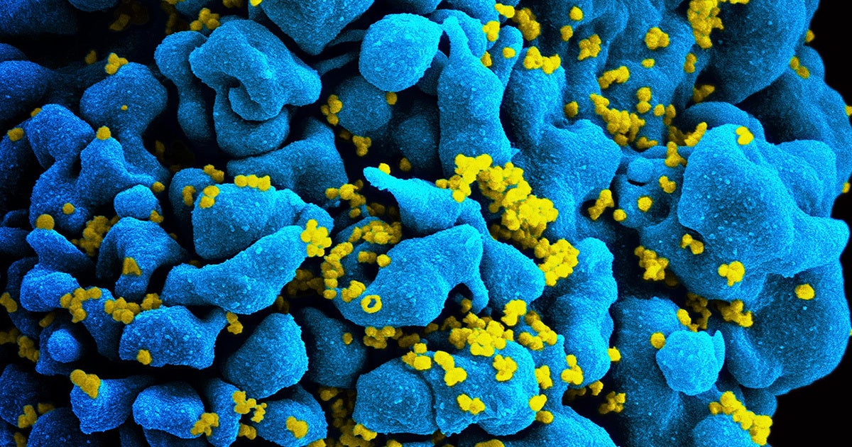 New research suggests that a woman is cured of HIV without taking any medications or getting a bone marrow transplant as other cured patients did.