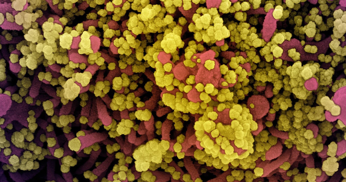 A coronavirus patient caught the disease on two separate occasions, and the second time around was even more severe than the first.