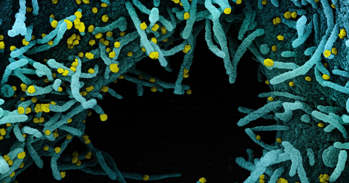 A woman died after catching the coronavirus, even though she had recovered from COVID-19 months prior. It's the first confirmed death linked to reinfection.