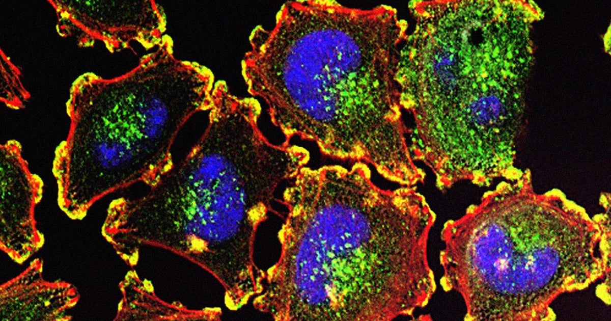 A team of researchers have designed a personalized cancer vaccine capable of inducing a years-long immune response that fights off melanoma.