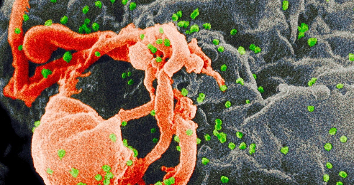 A new gene therapy for SCID, also known as "bubble baby" disease, uses HIV to deliver healthy genes that replace mutated ones.