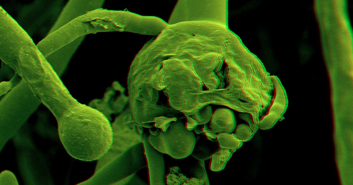 Cases of the brain-eating "black fungus" found in COVID-19 survivors and patients in India are now popping up in Pakistan as well.