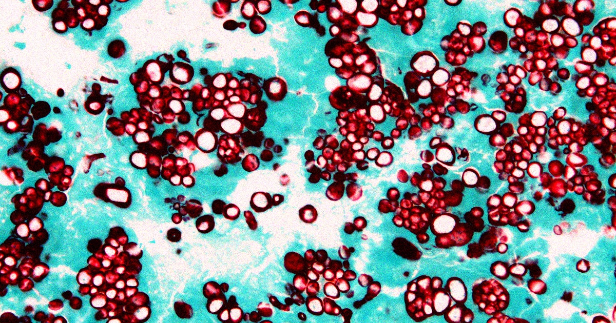 Tens of thousands of people in the US alone are being hospitalized by fungi a year, with millions more receiving treatment without being admitted.