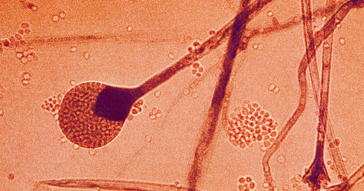 Doctors in India are battling a surprise wave of "black fungus" infections in coronavirus survivor's eyes, lungs, and brains.