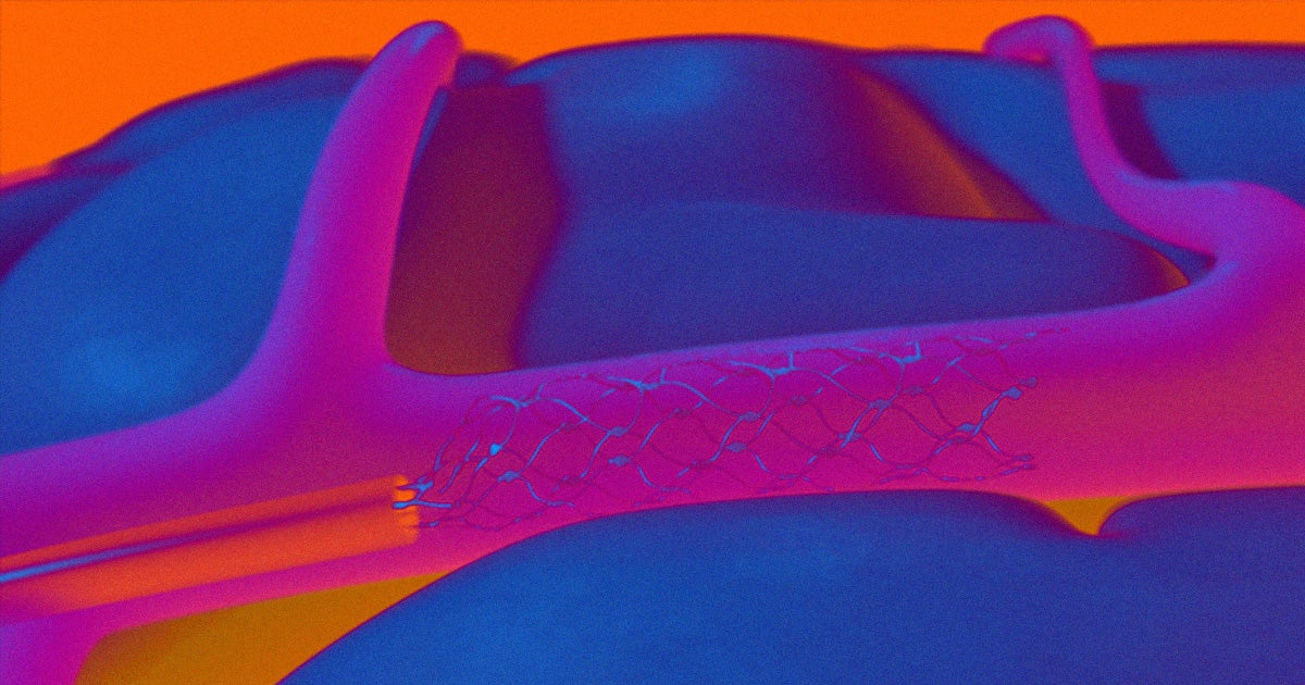 The neurotech company Synchron got FDA approval to start testing its brain implant in human volunteers, beating Neuralink and other rivals to the punch.