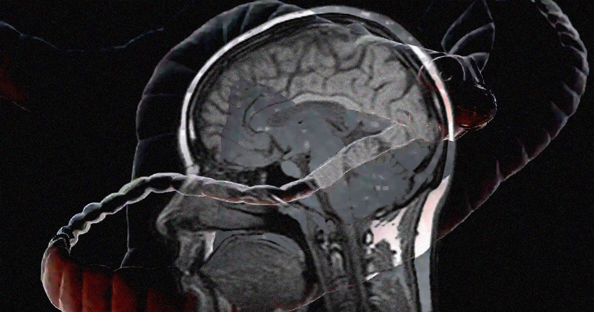 Doctors discovered a Massachusetts man who had tapeworms burrowed into his brain after ingesting feces-contaminated food years before.
