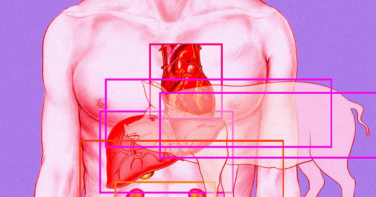 After celebrating a hallmark heart transplant in which a human patient received a pig heart, news outlets have been reporting on the man's troubled past.