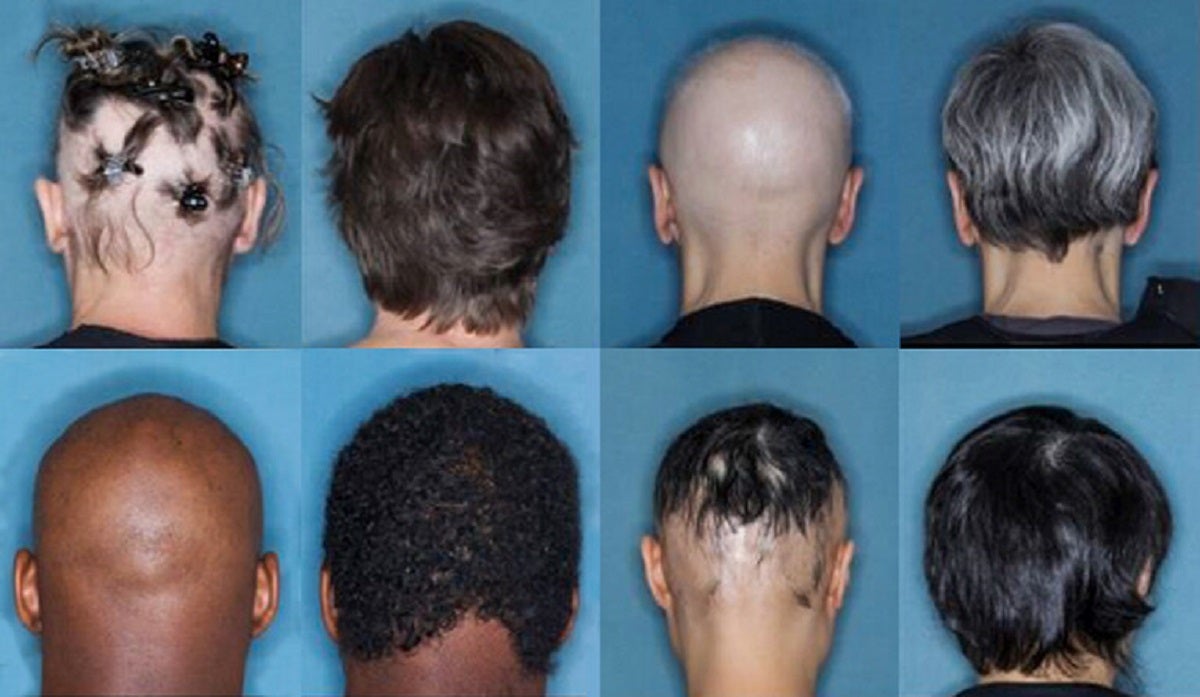 Scientists from Yale announced this week that a common arthritis medication is helping alopecia patients regrow their hair.