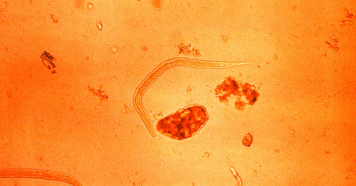 A Spanish man had a roundworm infection so bad that doctors could literally see the larvae slithering under his skin.