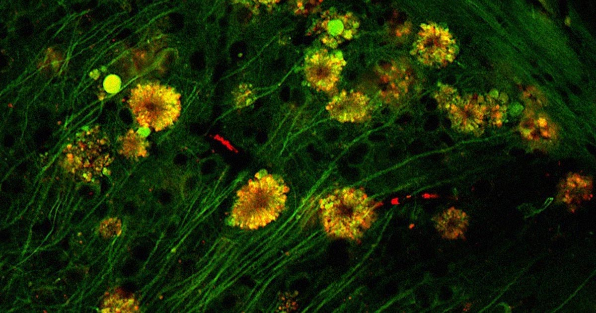 Neuroscientists are positing that issues with the brain's own waste removal system may be the root cause of Alzheimer's disease.