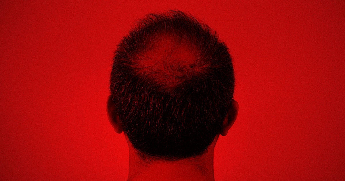 Low doses of minoxidil, the active ingredient in Rogaine, may reverse balding super cheaply — and yet most of us still haven't heard of it. 