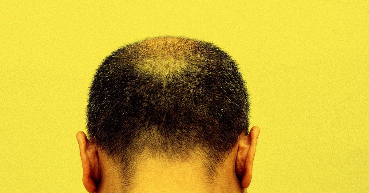 Using gene modification techniques, a team of researchers have come up with a new promising way to treat balding, a condition experienced by millions.