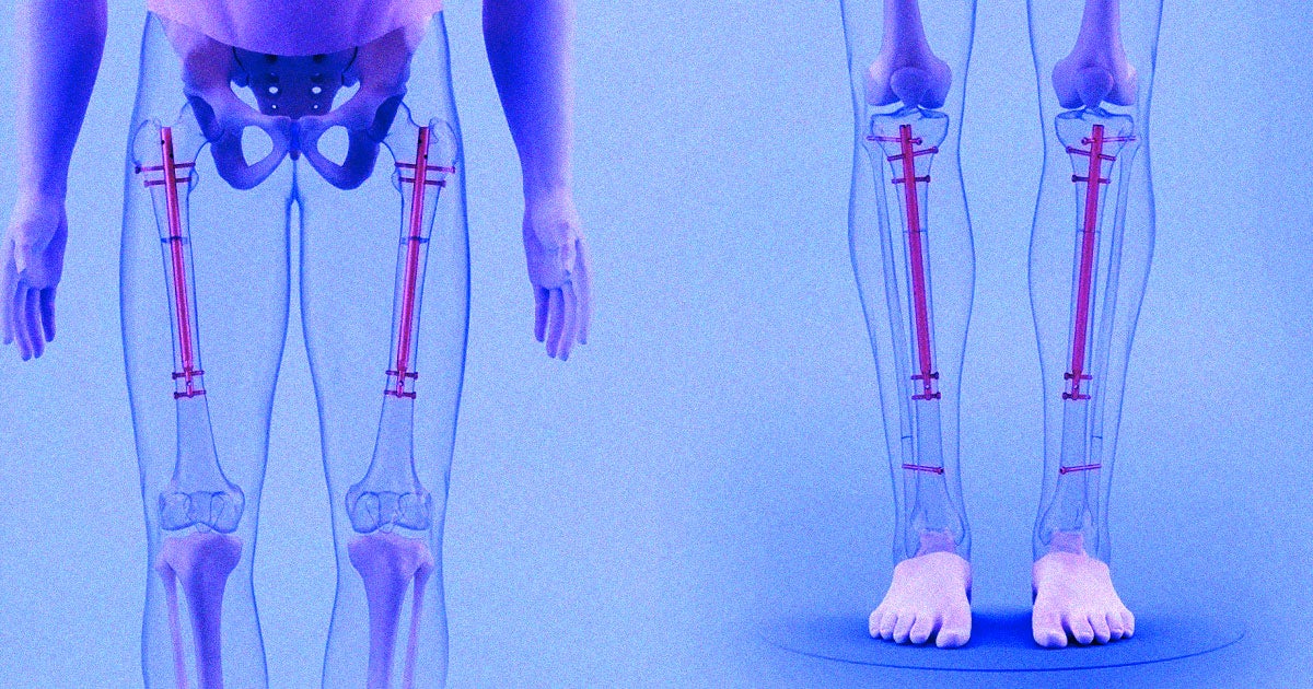 Some short men are so insecure about their heights that they are paying doctors to break their bones during surgical leg-lengthening procedures. 