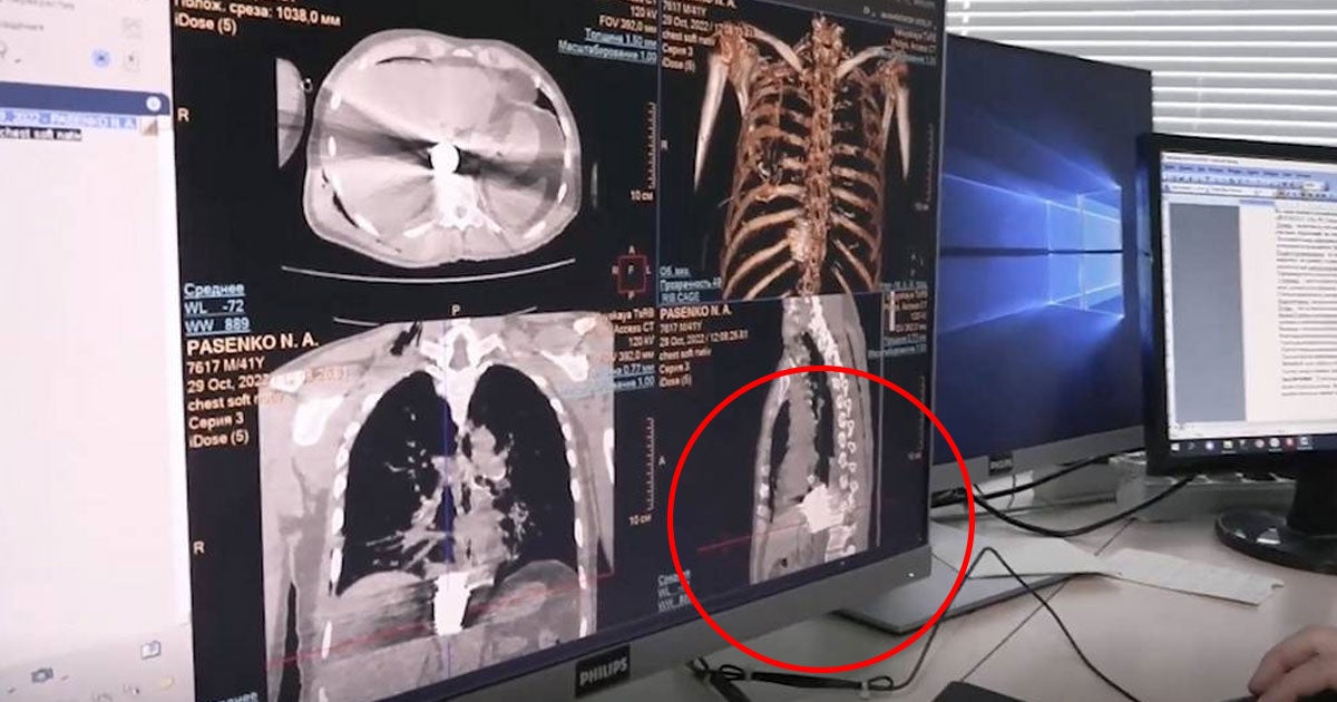Surgery had to quickly be performed to remove an unexploded shell lodged in a Russian soldier's chest with no guarantee it wouldn't detonate at any moment.