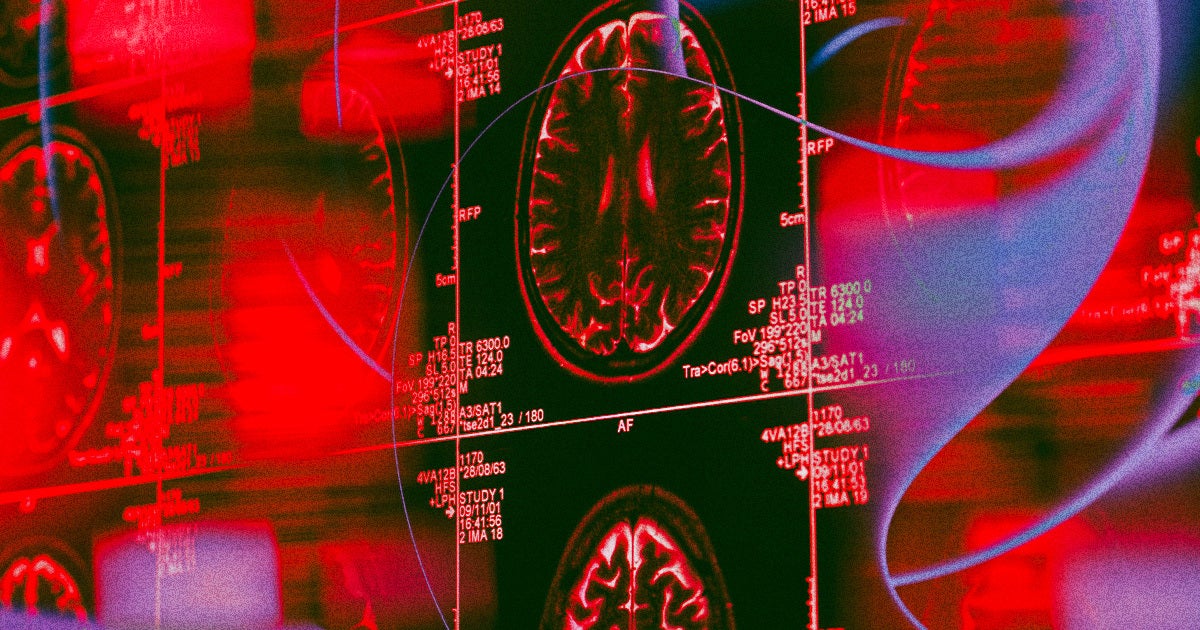 A new study mapped how high blood pressure affects regions of the brain from over 30,000 patients, showing changes also linked to dementia.