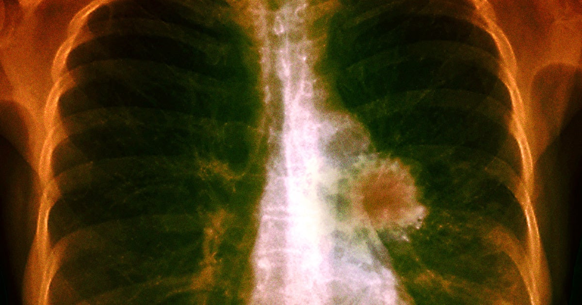 A decade-long global study has shown that a once-daily pill reduces the risk of dying from lung cancer by over half.